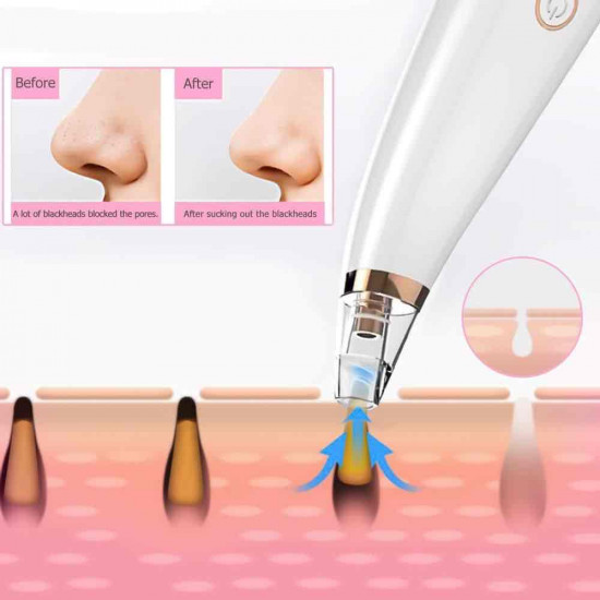 جهاز شفط دهون و زيوان و رؤس سوداء البشره بعدة مقاسات - شحن 