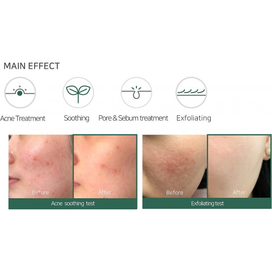 منظف الوجه الرغوي لحب الشباب المعجزة 30 يوما من سوم باي مي - 100مل منظف الوجه الرغوي لحب الشباب المعجزة 30 يوما من سوم باي مي - 100مل