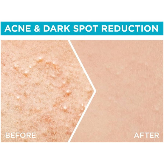 سيروم غارنييه سكين أكتيف فاست كلير بوستر للوجه، للبشرة مع حمض الساليسيليك، 15 مل