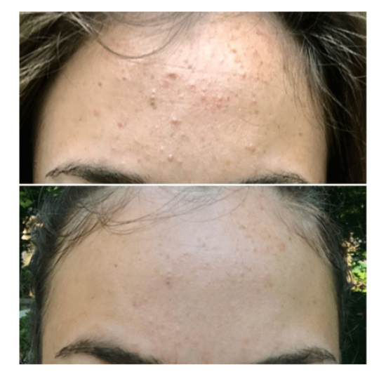 ستريدكس - مسحات قطنيه لعلاج حب الشباب ايسينشال - 55 قطعة قطن ستريدكس - مسحات قطنيه لعلاج حب الشباب ايسينشال - 55 قطعة قطن