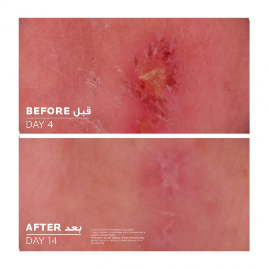 لاروش بوزيه سيكابلاست بوم بي 5+ كريم ملطف ومعالج 40 مل لاروش بوزيه سيكابلاست بوم بي 5+ كريم ملطف ومعالج 40 مل